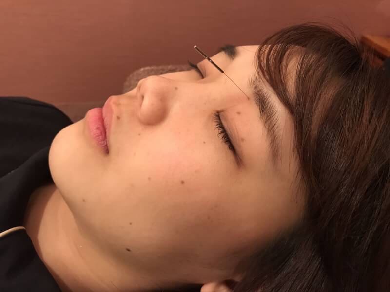 眼窩内刺鍼１