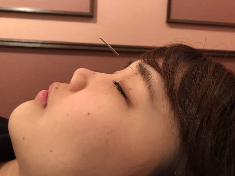 眼窩内刺鍼２